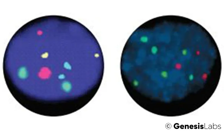 Cytology-FISH-v2 Genesis Labs Urovysion FISH